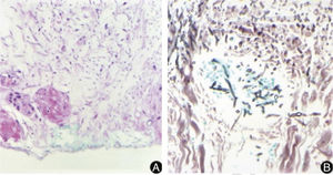 Histopathological examination of a lesion of the left upper limb, showing multiple septate, hyaline, and branched hyphae with angiolymphatic invasion. (A, Hematoxylin & eosin, ×10; B, Grocott, ×40).
