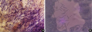 A, Direct examination of the skin lesion showing a large number of filamentous fungi; B, Microculture of the colony stained by lactophenol cotton blue, with macroconidia featuring characteristic canoe-type morphology.