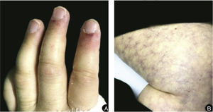 A, Paronychia in the second and third left fingers; B, Exuberant livedo reticularis affecting the entire lower limb.