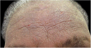 Patient with chronic eczema (intense lichenification on the forehead) due to allergic contact dermatitis from methyl isothiazolinone present in the shampoos used.
