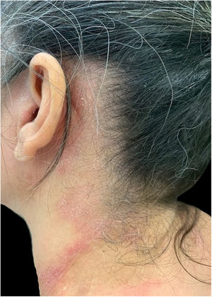 Patient with allergic contact dermatitis to components of the shampoos involving the pre-auricular, retroauricular, and lateral cervical regions (areas that come into contact with the shampoo when it is rinsed).