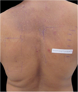 Patient with hyperchromia and abrasions on the back caused by pruritus from allergic contact dermatitis to cocamidopropyl betaine in shampoos (demonstrated by patch test).