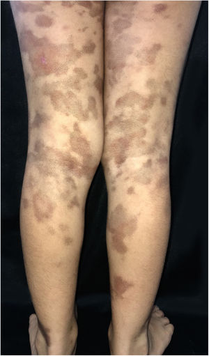 Multiple brownish macules on the legs and thighs.