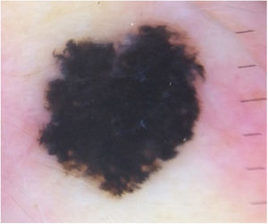 Spitz nevus: digital dermoscopy. Melanocytic lesion with a star-burst type global pattern.