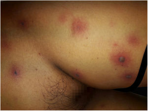 Invasive fusariosis, early clinical manifestations (left thigh). Dermatosis characterized by the presence of erythematous-violaceous macules, which coexist together with hemorrhagic blisters, situated on erythematous and infiltrated skin.