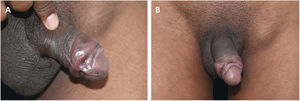 (A) Recent syphilis. Cord-like lesion (VDRL 1:128). (B), Notice the large-volume painless adenomegaly.