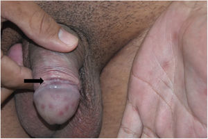 Cord-like lesion and underlying shallow ulcer along almost the entire indurated area. Notice the secondary lesions in the hand and glans.