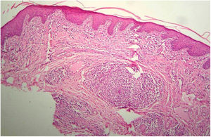 Hyperkeratosis and regular acanthosis of the epithelium. In the chorion, lymphoplasmacytic infiltrate surrounding superficial vessels (Hematoxylin & eosin, ×100).
