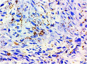 Immunohistochemistry − Patient # 1. Positive for Treponema pallidum.
