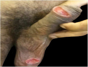 Patient 5, with painless ulcerated lesions in the scrotum and body of the penis.