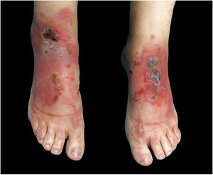 Erythematous, scaly, erosive, and crusty lesions on the dorsum of the feet.