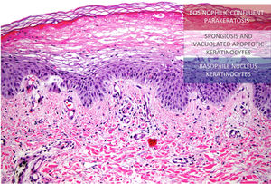 Histology of the lesions. Atrophic epidermis can be seen with moderate spongiosis and a central area with marked pallor due to the presence of apoptotic keratinocytes of vacuolated appearance below a more superficial layer of extensive hyperkeratosis and parakeratosis, producing a “tricolor flag” appearance (Hematoxylin & eosin, ×20).