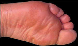Plantar hyperkeratotic patches with reddish dots.