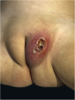 Skin ulcer in labia majora, seven days of evolution.