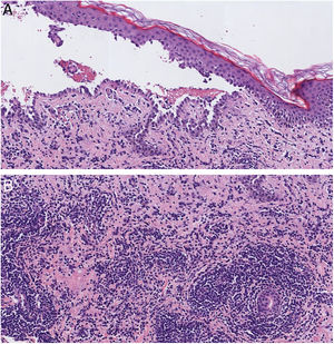 (A), Histopathology showed intraepithelial blister with acantholysis just above the basal keratinocytes and chronic inflammation (Hematoxylin & eosin, ×20). (B), A closer view of the dermis showed an unusual dense inflammatory infiltrate consisting mainly of lymphocytes with some isolated eosinophils (Hematoxylin & eosin, ×20).