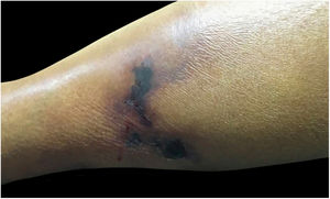 Irregular erythematous-violaceous plaques, with necrotic centers, located in the distal third of the lower limbs.