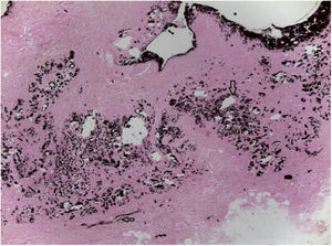 Positive Von Kossa stain on the material deposited in the dermis and blood vessel wall (arrows; ×100).