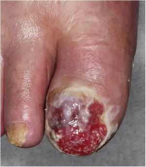 Physical examination revealed widespread erosion of the right hallux, which in part had a reddish nodule. The nail had completely disappeared.