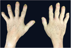 Dystrophic fingernails in quirodactyls.