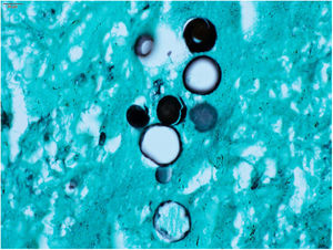 Paracoccidioidomycosis: Paracoccidioidesspp. Fungal cells, resembling a Mickey Mouse head. (Grocott-Gomori, immersion, 1000×).