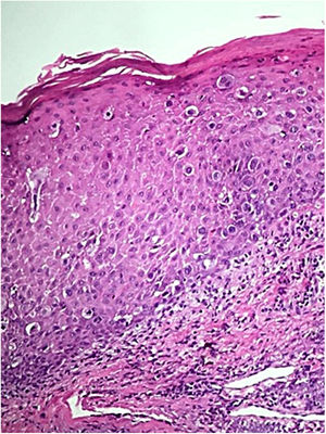 Epidermis showing infiltration by atypical epithelial cells with broad and clear cytoplasm (Hematoxylin & eosin, x100).