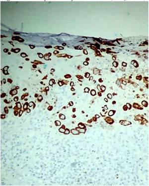 CK7-positive epithelial cells (Immunohistochemistry, x100).