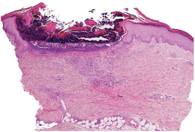Case for diagnosis. Hyperpigmented and excoriated papules and nodules ...