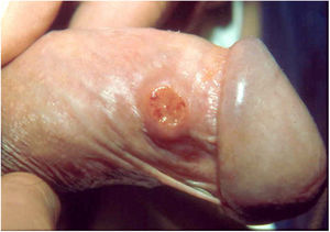 Nodular-ulcerated lesion located in the balanoprepucial groove.