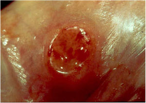 Ulcerated lesion located in the balanoprepucial groove, with granular background and bleeding. .