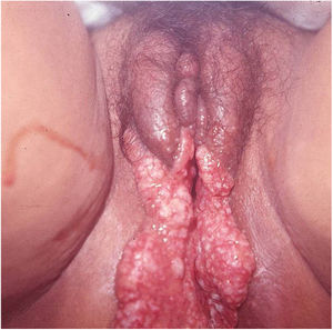 Lymphedema of the labia majora and minora with extensive, mirror-image vegetative ulcers (Image credits: Professor Sinésio Talhari and Professor Adele Benzaquem).
