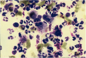 Histiocytes with Donovan bodies. Giemsa staining.