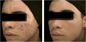 18-year-old teenager, with moderate inflammatory acne on the face and trunk for four years, presenting scars, with a relevant negative impact on quality of life. The patient had been submitted to four cycles of oral cyclin, associated with topical combination of benzoyl peroxide and adapalene, with improvement and recurrence after two to three months. During the last cycle, the clinical picture worsened. The patient was treated with oral isotretinoin, 40mg/kg/day (0.6mg/kg/day), with total lesion regression after four months and maintenance for another month (total dose=100mg/kg/day) – regimen based on recent publications.77,80–82 Photos before and after treatment with oral isotretinoin. Maintenance treatment with adapalene 0.1% gel, for 12 months. There was no recurrence.