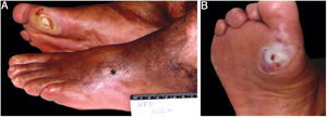 Diabetic patient: (A), scar of arterial ulcer (*) on the left foot and neuropathic ulcer over the first right metatarsal; (B), thinned peripheral calluses.
