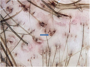 Brown pigmentation at the edge of the follicular ostium by anthralin (blue arrow); differentiate from the black dots that are in the center of the ostium.