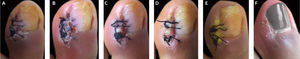 Post-operative healing process. (A) 3rd day, (B) 4th day, (C) 5th day, (D) 6th day, (E) 14th day, (F) 4th week.