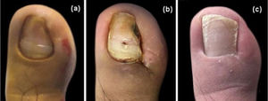 Cosmetic result. (A), Preoperative image. (B), After stitch removal on the 14thday. (C), Follow-up after one year.