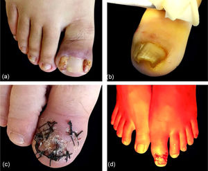 Key points. (A), Large masses in triangular regions. (B), Thick nail plate. (C), Remove the entire nail plate before the operation. (D), Management with water-filtered infrared-A (wIRA).