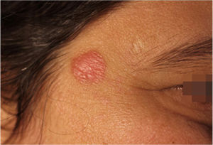 Circular, erythematous plaque, with sharp edges and smooth surface, approximately 1.2 cm in diameter, on the right temporal region.