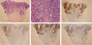 (A), Skin biopsy showing an intense lymphocytic infiltrate filling the interstitial region of the papillary dermis and part of the superficial reticular dermis, predominantly in the upper part of the dermis (Hematoxylin & eosin, ×40). (B), In the highlight, there is a predominance of small lymphocytes with slight nuclear atypias (slight increase in nuclear volume and slight irregularity in nuclear contours) in addition to areas containing plasma cells and histiocytes (Hematoxylin & eosin, ×400). (C), (CD3 – ×40) Immunohistochemical exam showing a predominance of T lymphocytes CD3 positive. (D), (CD20 – ×40) Immunohistochemical exam showing CD20 immunoexpression (B lymphocytes) in part of the infiltrate. (E), (CD4 – ×40) A slight predominance of CD4 positive T lymphocytes can be observed in the infiltrate. (F), (CD8 – ×40) CD8 showing less immunoexpression than CD4.