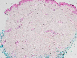 Histopathological examination at low magnification, which was initially interpreted as morphea (Hematoxylin & eosin, ×100).