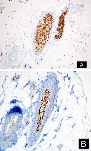 Tumor cells positive with CD20 (A: DAB, ×200), and MUM-1 (B: DAB, ×200).