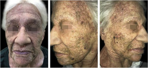 Multiple skin-colored to erythematous to brownish, 1 − 2 mm papules, with a slightly keratotic center, sometimes coalescing into verrucous plaques; koebnerization is also present.