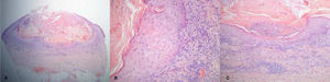 Histological examination. A, Well-demarcated, crateriform lesion filled with a predominantly orthokeratotic keratin plug, with some areas of parakeratosis. B, Surrounding epithelium showing mild irregular acanthosis and cells with abundant ground-glass cytoplasm, displaying minimal atypia and pleomorphism at the basal layer. C, Intratumoral neutrophilic microabscesses and lymphocytic inflammatory infiltrate in the underlying dermis. (Hematoxylin & eosin, A × 40; B × 200; C × 100).