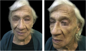 Regression of numerous lesions after 7 weeks of therapy with acitretin.