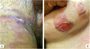(A), Two superficial oval ulcers over striae in the inguinal region. (B), Beefy red oval ulcer over a wide atrophic stria with telangiectasia, extending from the anterior to the inferior aspect of breast. Active tinea corporis is observed.