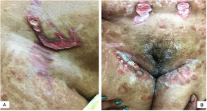 (A), Multiple, wide, beefy red, ulcerated striae over abdomen. Similar appearance, as well as linearly oriented oval ulcers in inguinal region. Widespread steroid-modified tinea corporis is observed. (B), Beefy red linear ulcers with hyperpigmented overhanging borders limited to the striae. Two superficial ulcerations on adjacent striae. Tinea corporis is observedin the background.