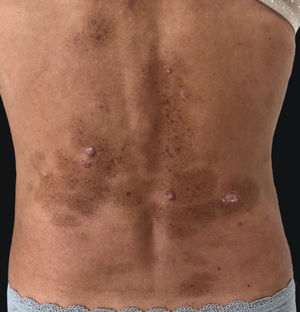 Multiple brownish macules in areas previously occupied by psoriatic plaques.