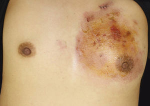 Clinical features of the trunk. A reddish induration with tenderness and swelling on the left breast.