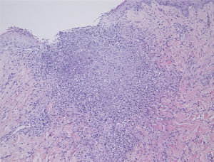 The histopathological specimen showed basophilic degeneration of collagen fiber, mixed with numerous nuclear debris in the upper dermis (Hematoxylin & eosin, ×100).