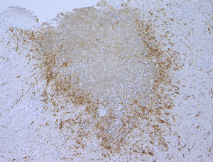Palisaded histiocytes surrounding degenerated collagen fibers (CD68, ×100).